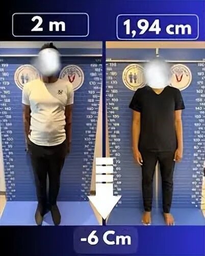 太疯狂！嫌个子太高不好找对象 女子手术切骨变矮