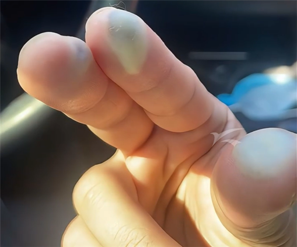 别名“化骨水”！女子散步时踩到氢氟酸后不幸去世