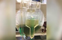 2020年十大怪异病例：绿色尿液和“膀胱酿酒”