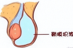 “蛋蛋”一大一小，鼓个大包？小小手术，解除大大负担
