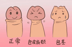 这四种情况需要做包皮手术，请对号入座 