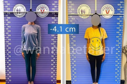 太疯狂！嫌个子太高不好找对象 女子手术切骨变矮