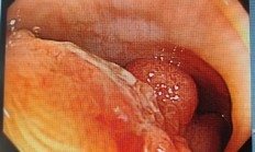 女子体内塞满密密麻麻的息肉！差点拖成癌症