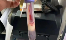 男子饭后肚子剧痛抽出牛奶血：平时经常点外卖