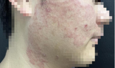 宁波小伙拿擦脚巾擦脸 结果脚气上脸！专家：有人闻臭袜肺部感染