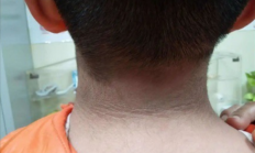 13岁男孩脖子洗不干净确诊黑棘皮病：胰岛素失控所致