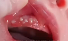 消毒险酿致命错！2个月宝宝被奶奶擦碘伏进ICU