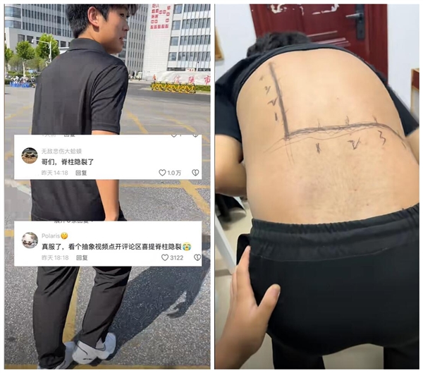 男生拍抽象视频被网友诊断为脊柱隐裂:神了