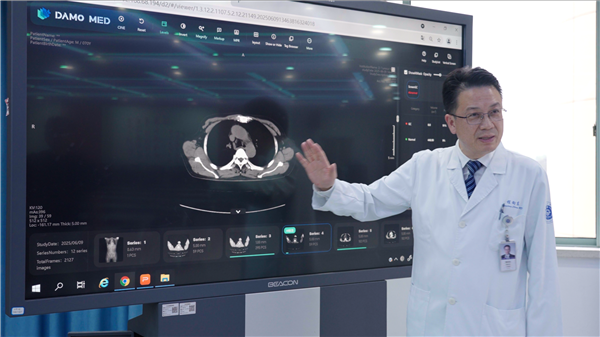 阿里巴巴发布全球首个胃癌影像筛查AI模型:CT就能识别早期胃癌