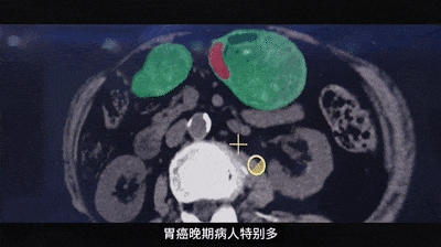 为了消灭癌症 他们把几千份遗憾喂给代码