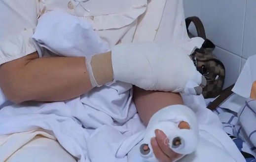 贵阳阿姨河道捡到漂亮石头 竟自燃导致自己四肢烧伤