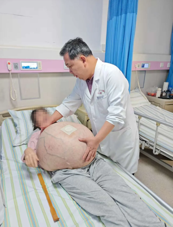 河北一女子肚子长80斤罕见巨瘤:血管暴突如蛛网 4小时切下