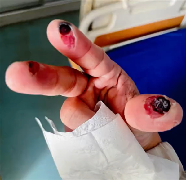 别名“化骨水”！女子散步时踩到氢氟酸后不幸去世