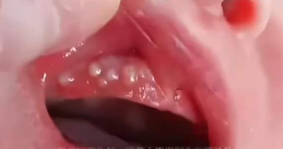 消毒险酿致命错!2个月宝宝被奶奶擦碘伏进ICU